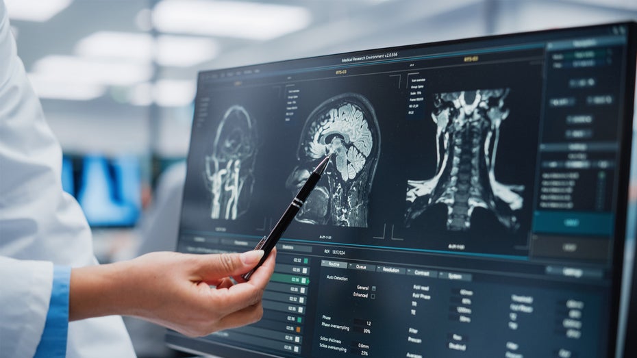 Psychische Erkrankungen: KI ermöglicht neue Erkenntnisse in der Genforschung