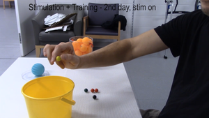 Dieser Rückenmarkstimulator gibt gelähmten Menschen eine bessere Kontrolle über ihre Hände