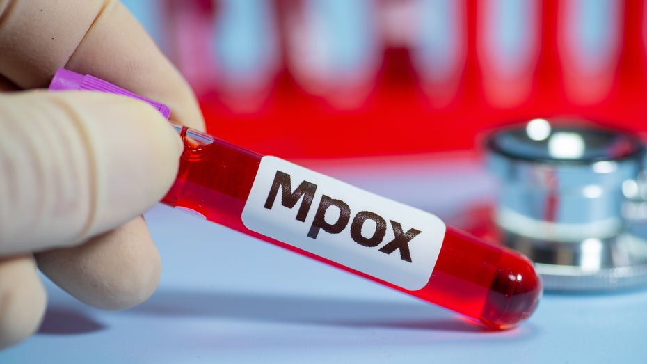 Mpox ist in Afrika in einigen Staaten auf dem Vormarsch. (Symbolbild: QINQIE99 / shutterstock.com) Mpox-Ausbruch in Afrika: Ein Experte erklärt, was jetzt wichtig ist